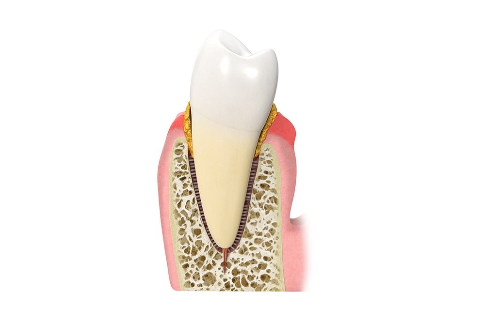 Stage 3: broken gums, pockets forming and beginning of mild periodontal gum disease