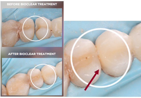 Bioclear®