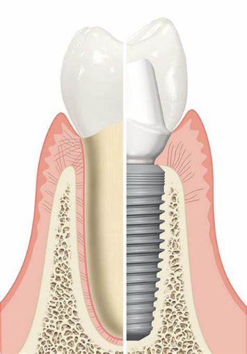 Comparing a tooth to a dental implant