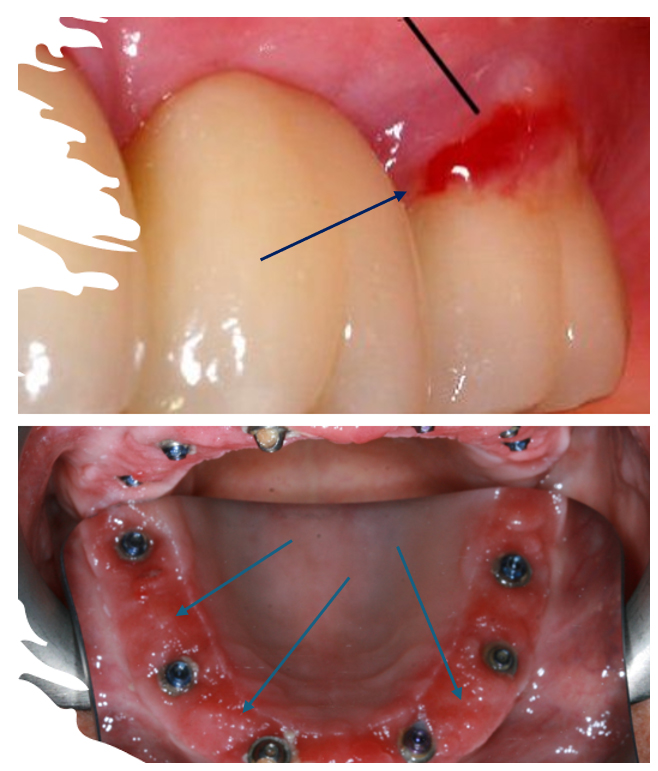 Mucositis on a single tooth, and under a bridge which was not being kept cleaned