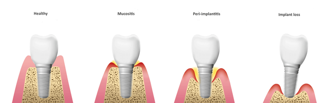 Progression from health to mucositis (reversible) to peri-implantitis, which can lead to implant loss