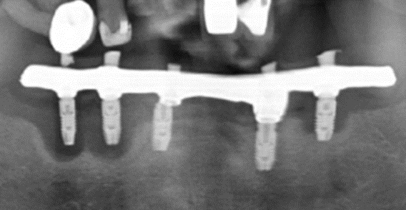 Bone loss ( dark areas) around 3 implants, with chronic infection and failure