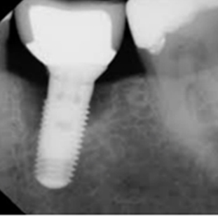 Mucositis on a single tooth, and under a bridge which was not being kept cleaned