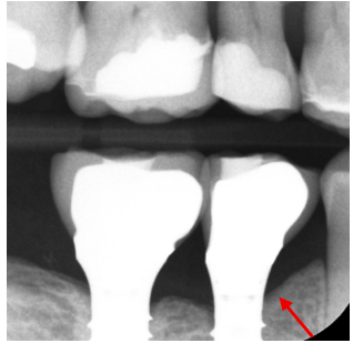 Healthy bone