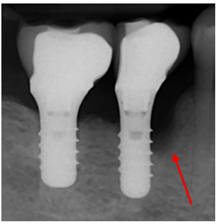 Peri-implantitis and bone loss