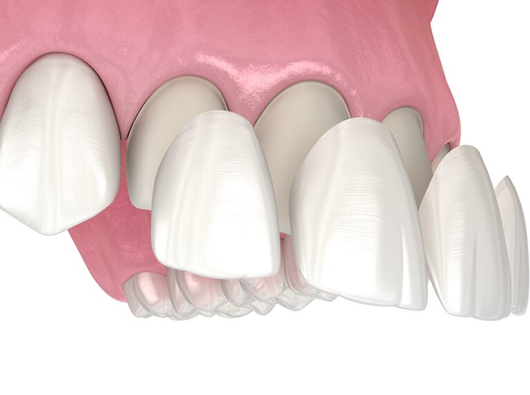 Dental Veneers - being applied to teeth