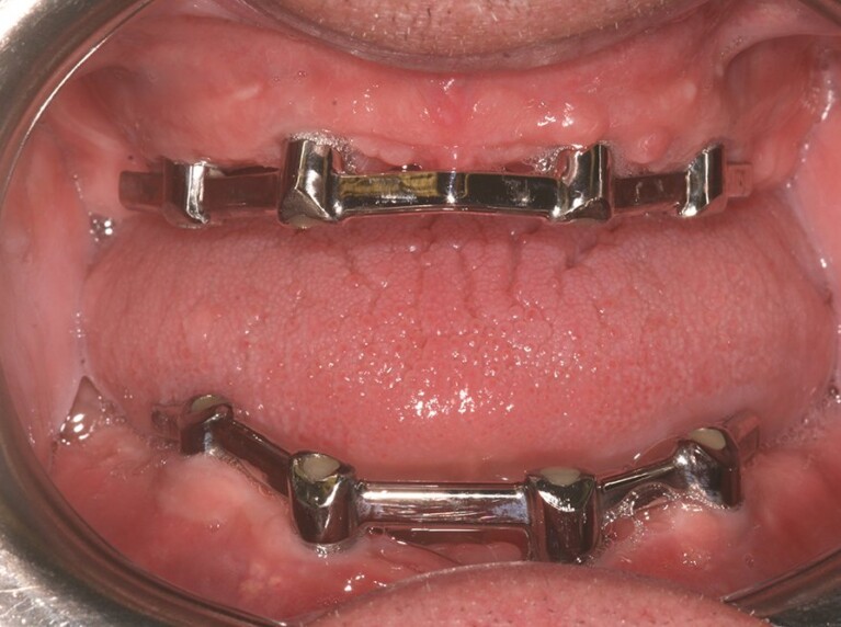 Dental implants - bar example
