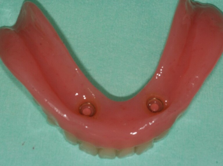 Dental implants - fitting surface locator denture