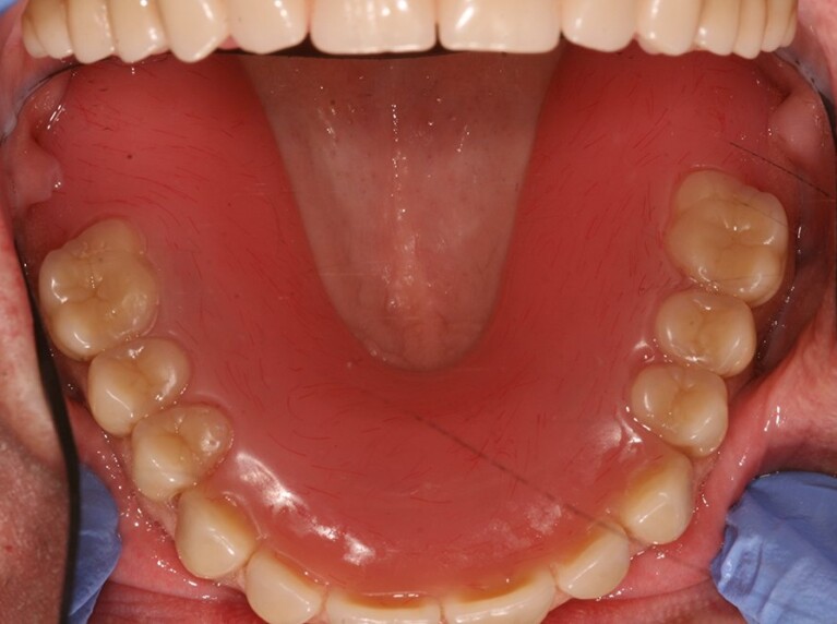 Dental implants - implant retained denture palate free upper