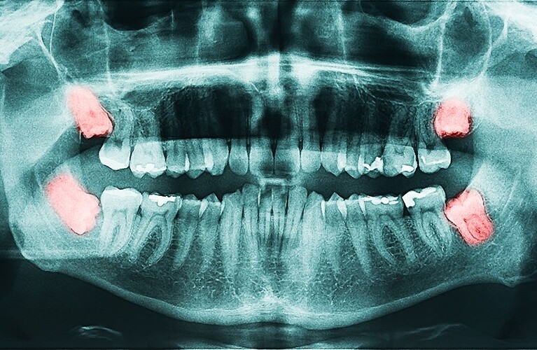 Dental x-ray showing wisdom teeth