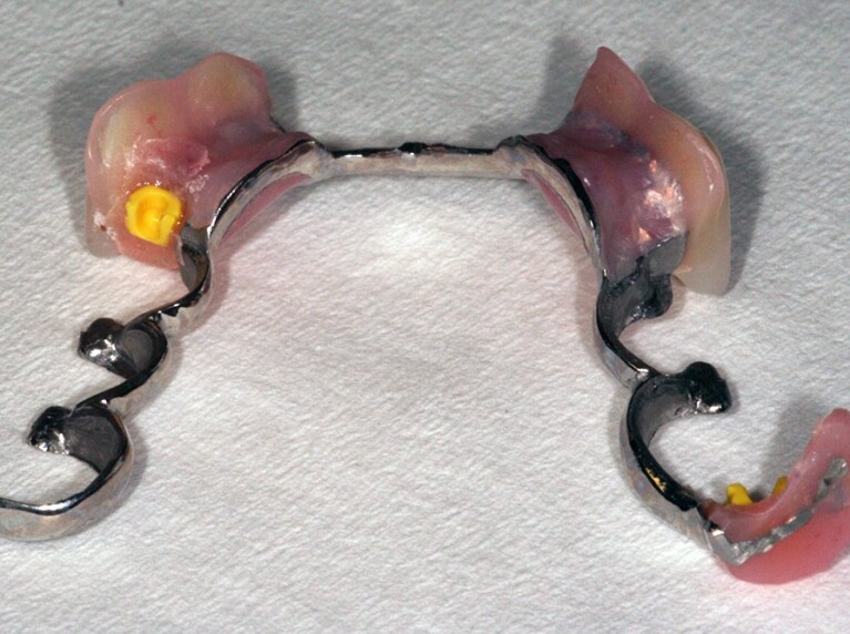 Precision attachment denture from below