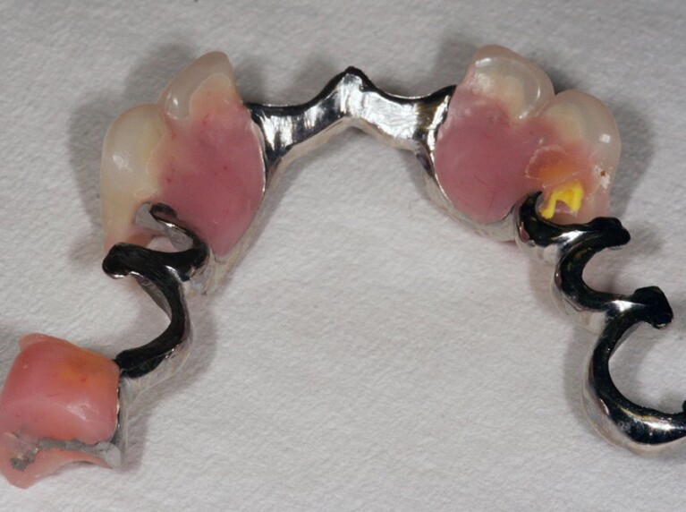 Precision attachment denture